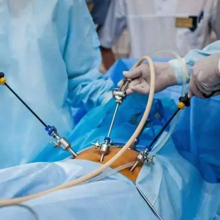 LAPAROSCOPY